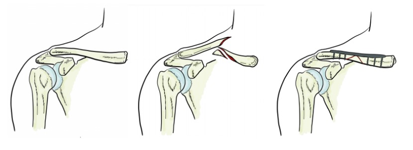 Trauma Surgery – Dr Jarrad Stevens – Orthopaedic Surgeon Melbourne